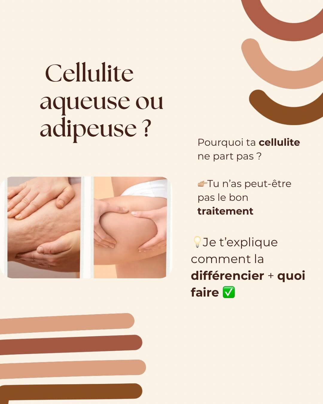 Cellulite aqueuse ou adipeuse